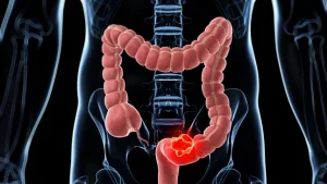 Analizan tumores de hasta 100 años para entender el aumento del cáncer intestinal en jóvenes