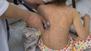 alerta-de-la-oms:-retorno-de-la-transmision-endemica-del-sarampion-en-espana