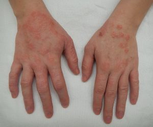 ¿como-prevenir-brotes-de-dermatitis-atopica?