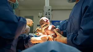 un-bebe-nacio-‘dos-veces’-en-eeuu.-tras-una-operacion-pionera