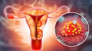 cancer-de-ovario-en-rd:-mas-del-70%-de-los-casos-se-detecta-tarde