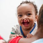 Fundación Operación Sonrisa República Dominicana convoca a pacientes para cirugías gratuitas de labio y paladar hendido
